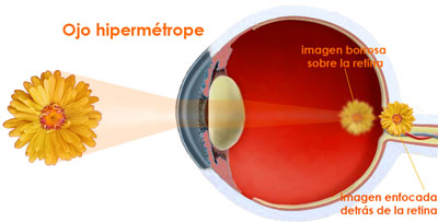 Deficiențele vizuale: Ce este Hipermetropia? Simptomele, cauzele și tratamentul | Blog nmforum.ro
